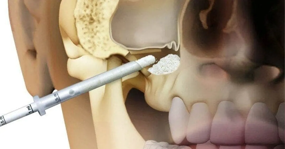 Sinus Lifting (Sinüs Kaldırma) Nedir? Sinüs Sarkması Belirtileri Nelerdir?