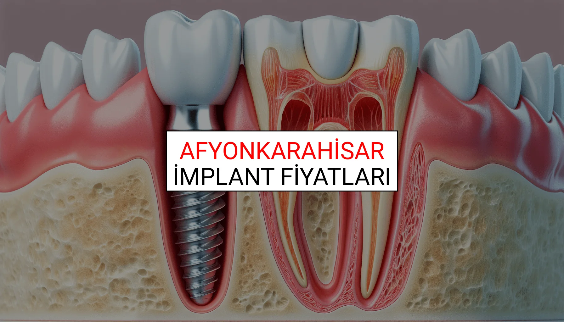 Afyonkarahisar İmplant Fiyatları Ne Kadar? (2025 TDB İmplant Diş Fiyatları)