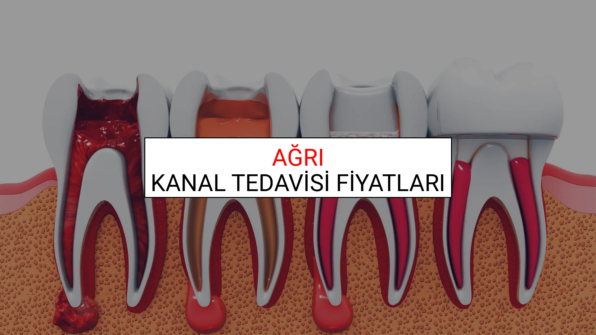 Ağrı Kanal Tedavisi Fiyatları Ne Kadar? (2025 Ağrı Kanal Tedavisi Endodonti Fiyatları)
