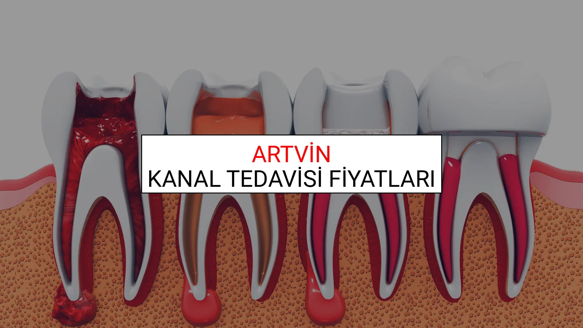 Artvin Kanal Tedavisi Fiyatları Ne Kadar? (2025 Artvin Kanal Tedavisi Endodonti Fiyatları)