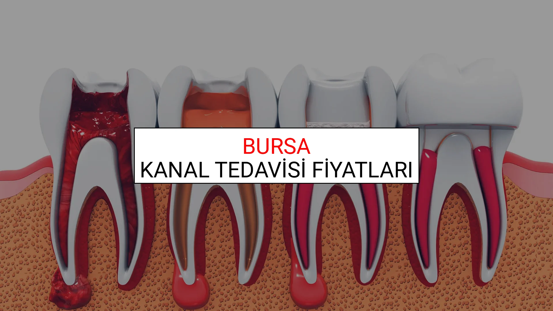 Bursa Kanal Tedavisi Fiyatları Ne Kadar? (2025 Bursa Kanal Tedavisi Endodonti Fiyatları)