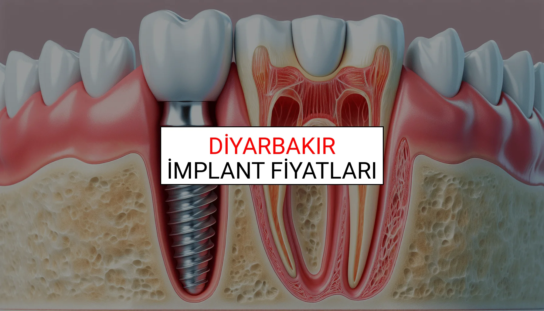 Diyarbakır İmplant Fiyatları Ne Kadar? (2025 TDB İmplant Diş Fiyatları)