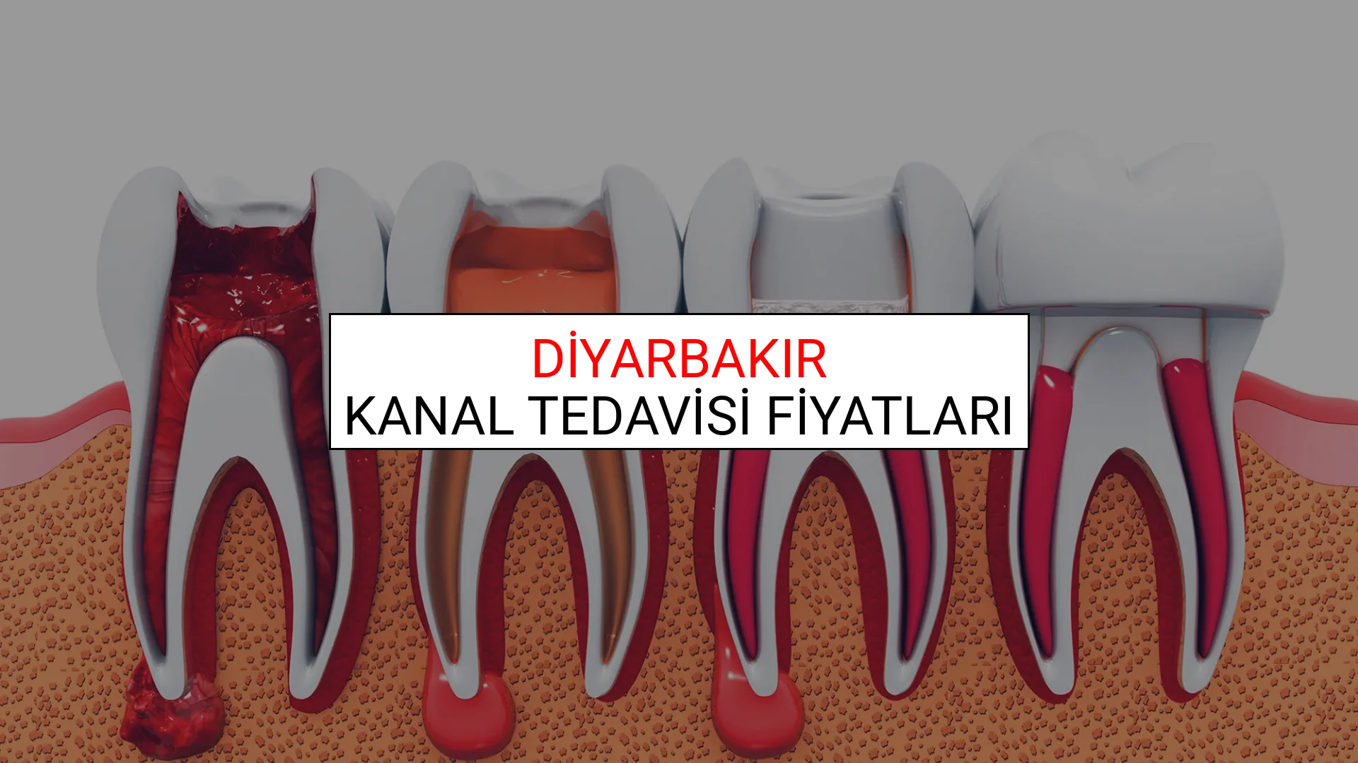 Diyarbakır Kanal Tedavisi Fiyatları Ne Kadar? (2025 Diyarbakır Kanal Tedavisi Endodonti Fiyatları)