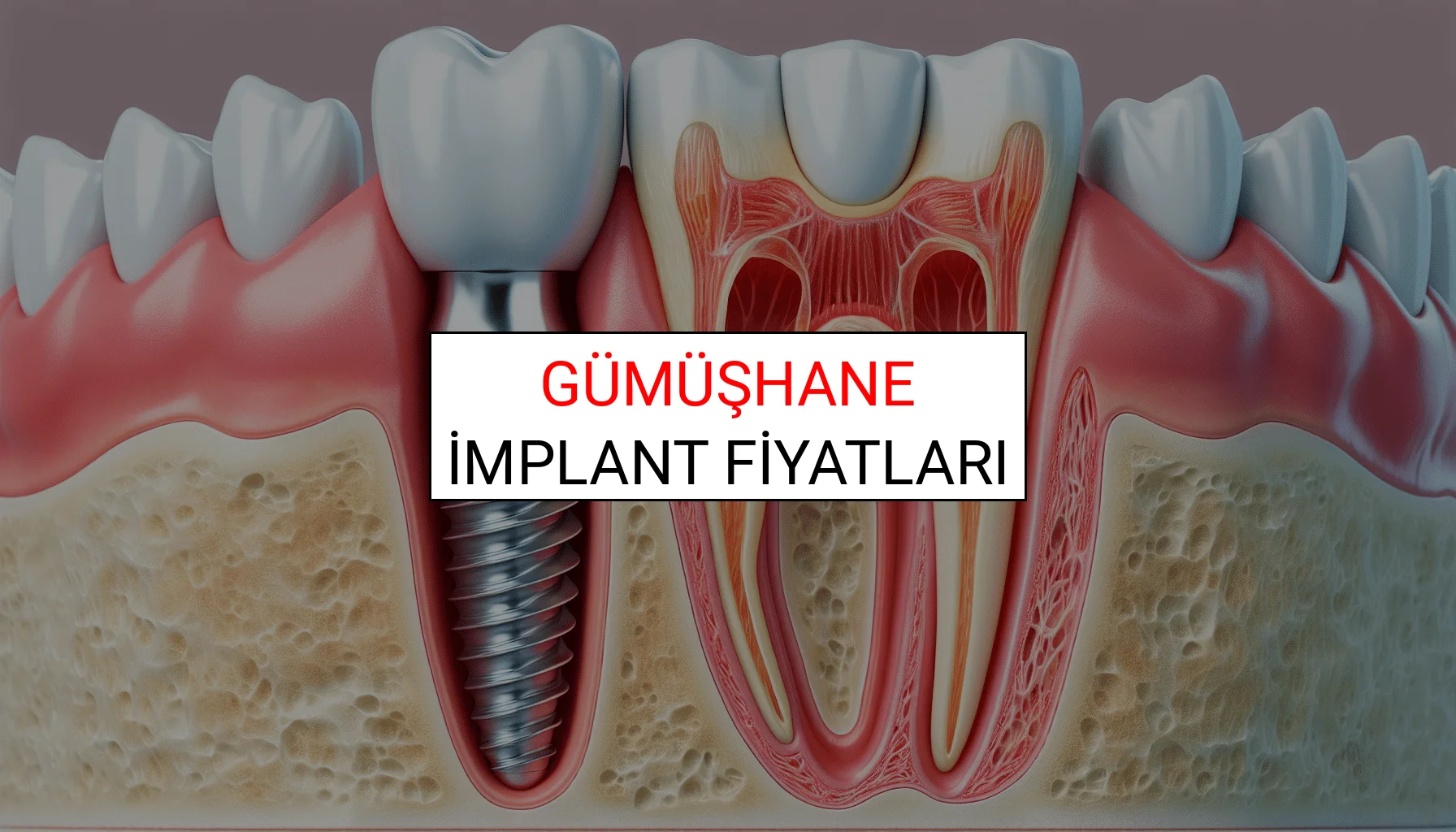 Gümüşhane İmplant Fiyatları Ne Kadar? (2025 TDB İmplant Diş Fiyatları)