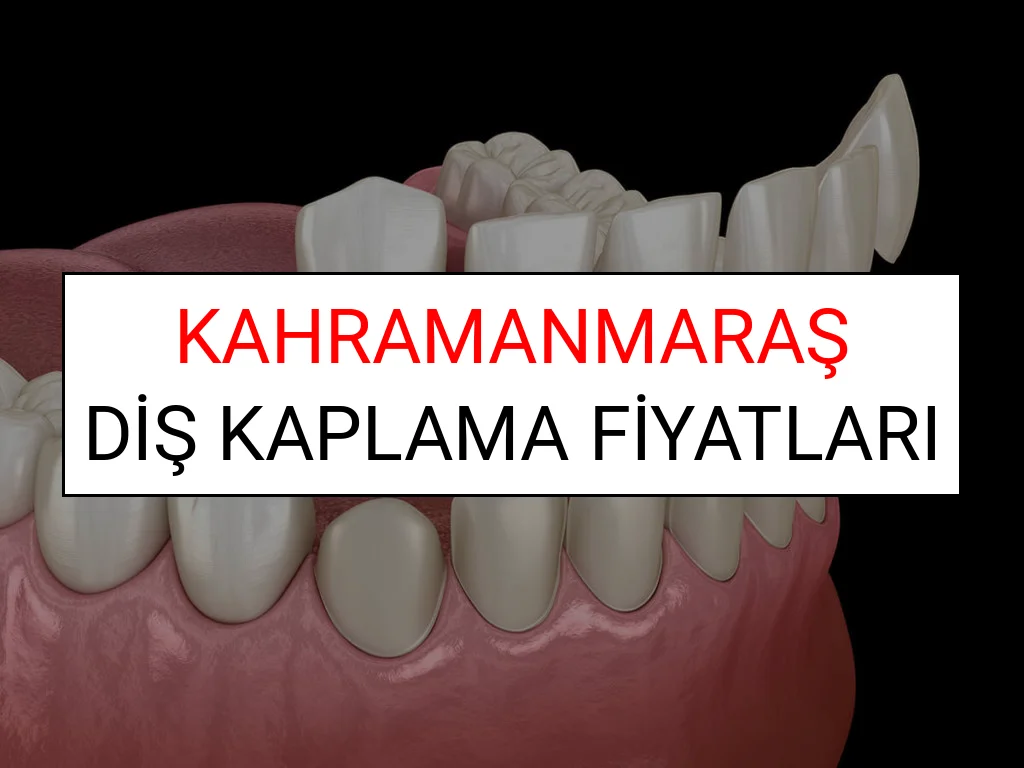 Kahramanmaraş Diş Kaplama Fiyatları Ne Kadar? (2025 Kahramanmaraş TDB Diş Kaplama Fiyatları)