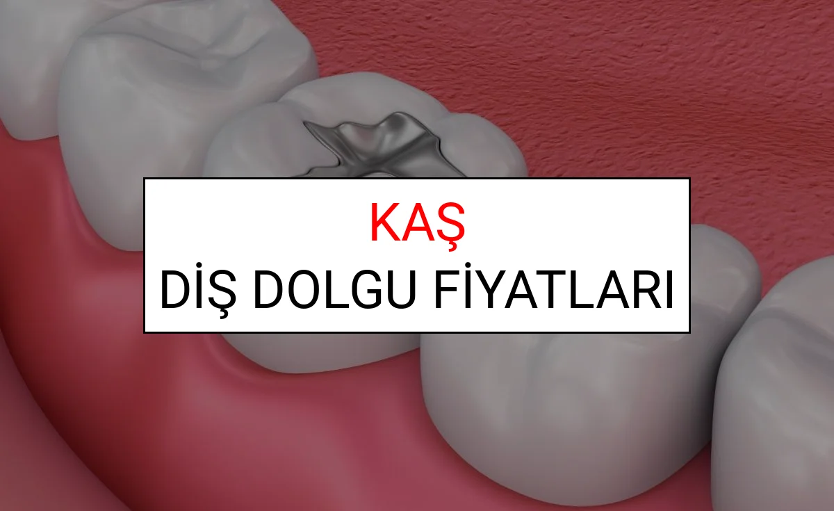 Kaş Diş Dolgu Fiyatları Ne Kadar? (2025 TDB Kaş Diş Dolgu Ücreti)