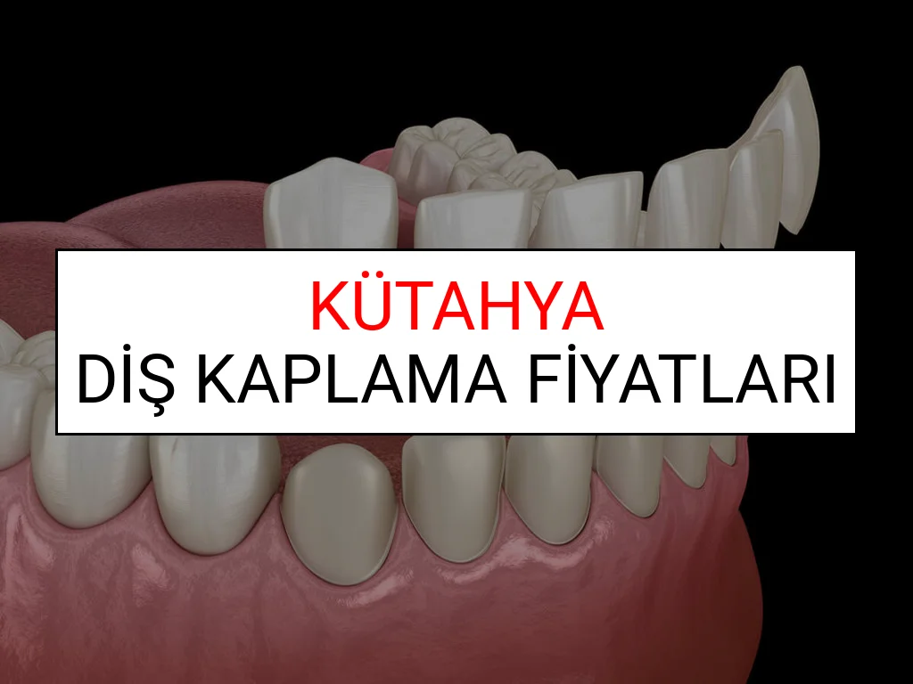 Kütahya Diş Kaplama Fiyatları Ne Kadar? (2025 Kütahya TDB Diş Kaplama Fiyatları)