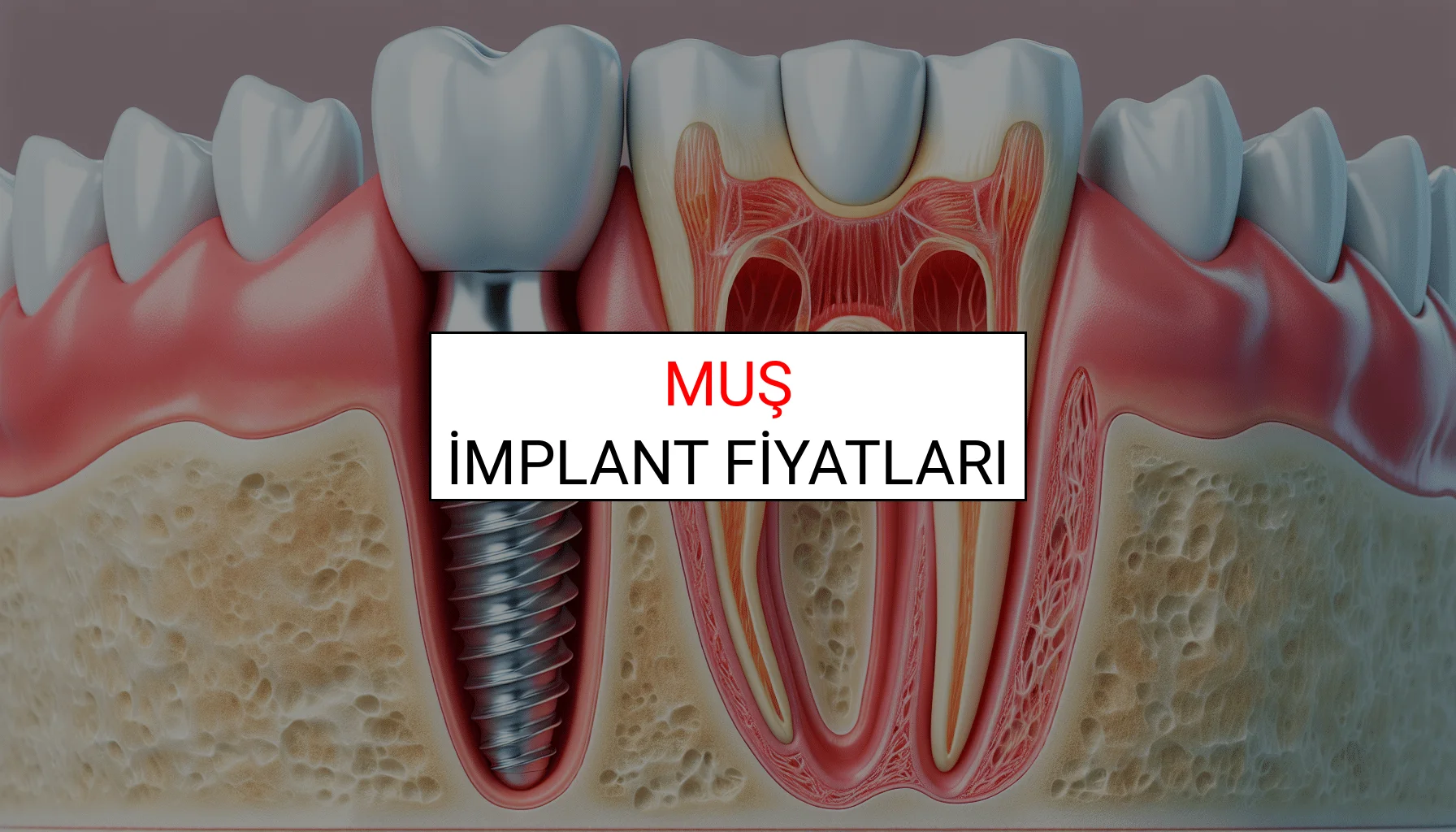 Muş İmplant Fiyatları Ne Kadar? (2025 TDB İmplant Diş Fiyatları)