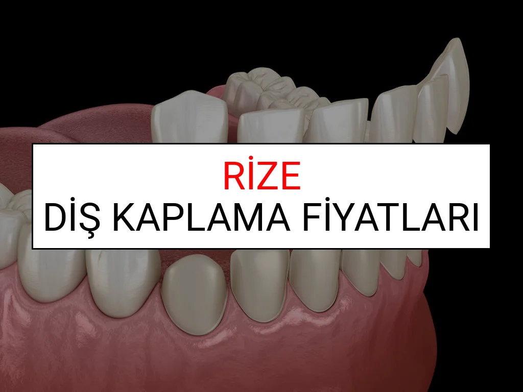 Rize Diş Kaplama Fiyatları Ne Kadar? (2025 Rize TDB Diş Kaplama Fiyatları)