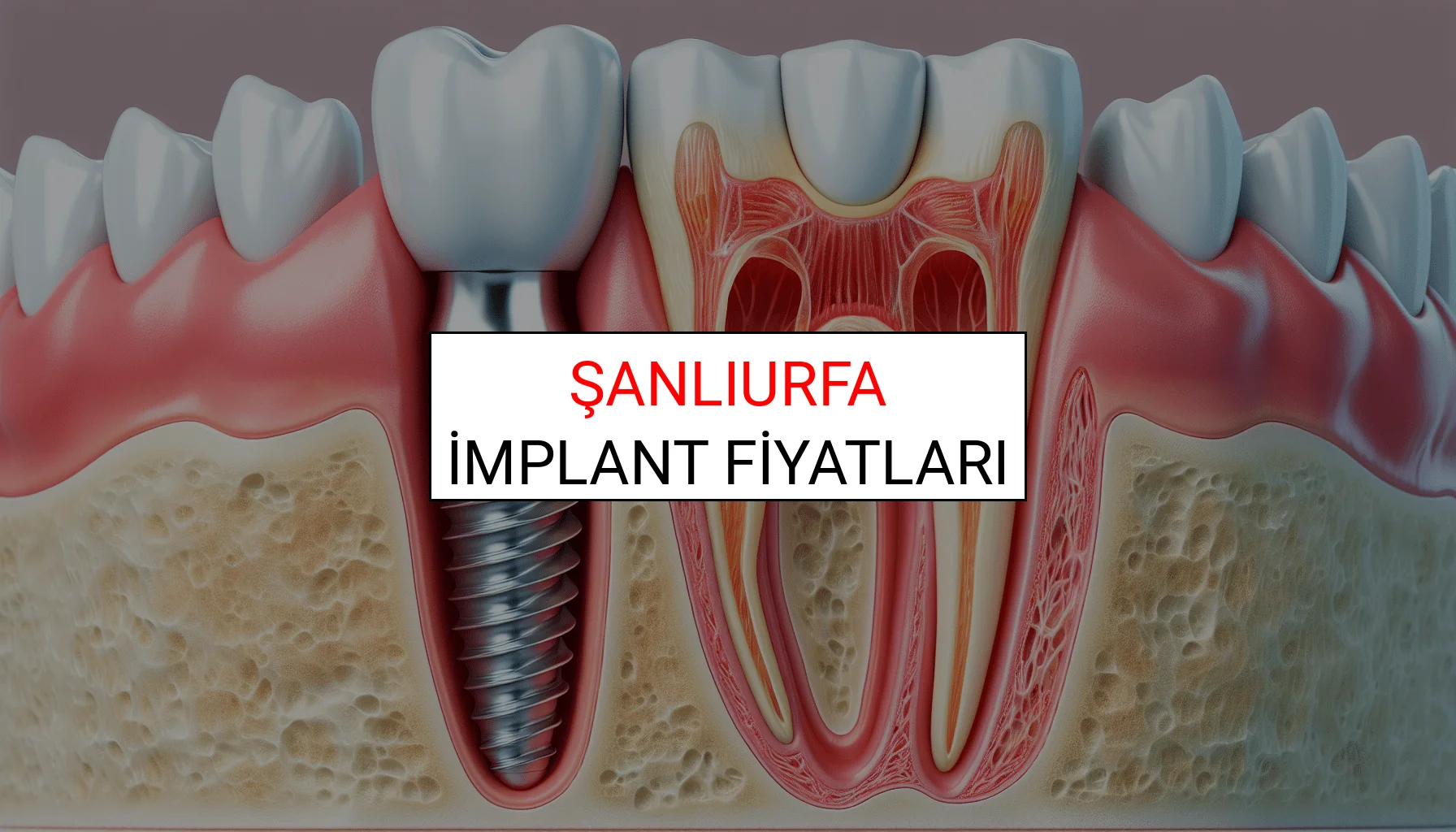 Şanlıurfa İmplant Fiyatları Ne Kadar? (2025 TDB İmplant Diş Fiyatları)