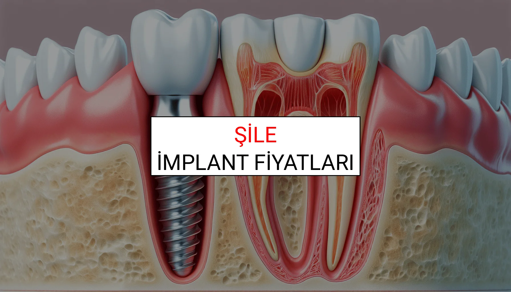 Şile İmplant Fiyatları Ne Kadar? (2025 TDB İmplant Diş Fiyatları)