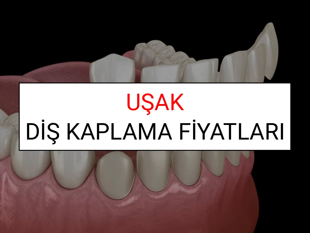 Uşak Diş Kaplama Fiyatları Ne Kadar? (2025 Uşak TDB Diş Kaplama Fiyatları)