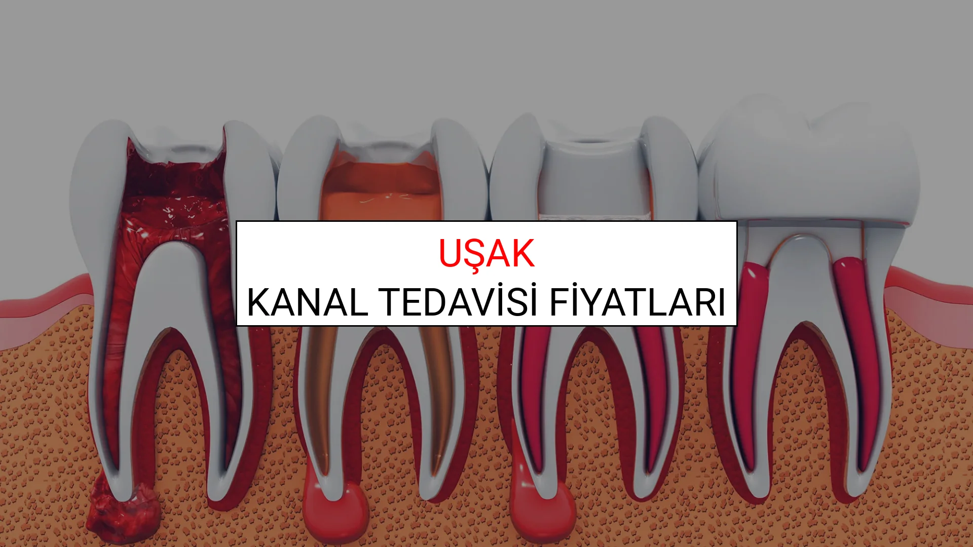 Uşak Kanal Tedavisi Fiyatları Ne Kadar? (2025 Uşak Kanal Tedavisi Endodonti Fiyatları)