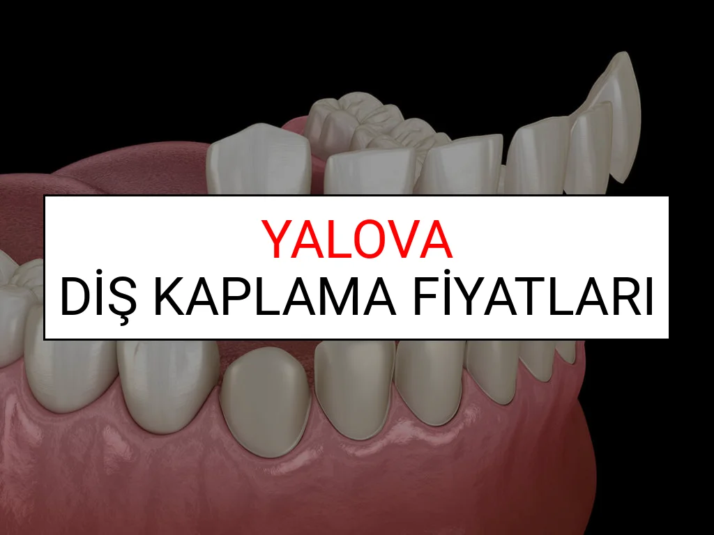 Yalova Diş Kaplama Fiyatları Ne Kadar? (2025 Yalova TDB Diş Kaplama Fiyatları)