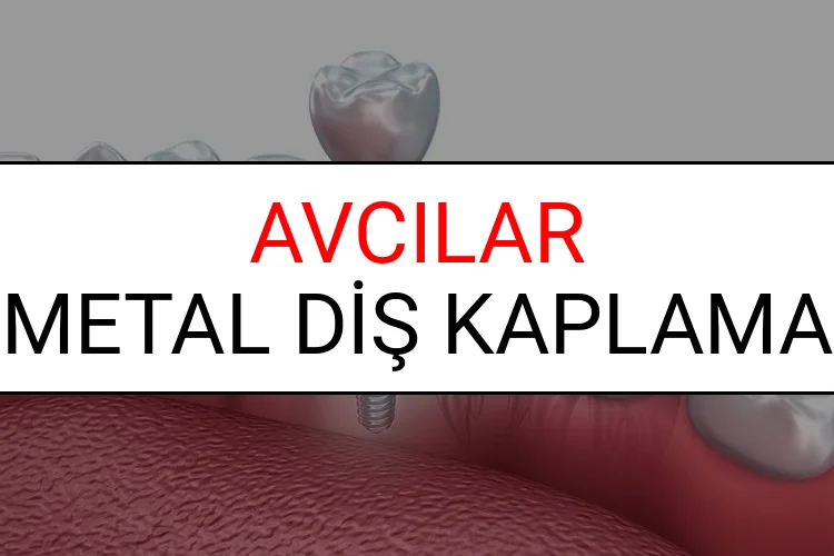 Avcılar Metal Diş Kaplama Fiyatları Ne Kadar? (2025 Avcılar TDB Metal Destekli Diş Fiyatları)