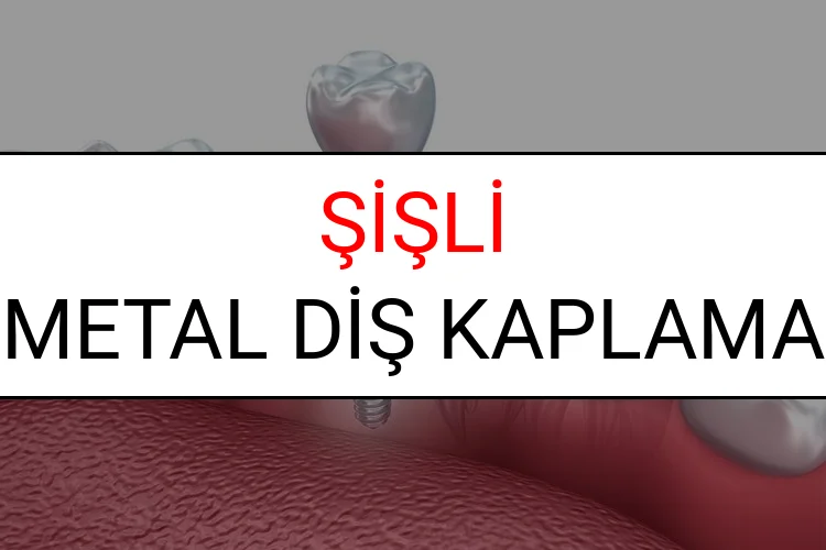 Şişli Metal Diş Kaplama Fiyatları Ne Kadar? (2025 Şişli TDB Metal Destekli Diş Fiyatları)