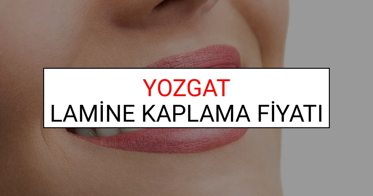 Yozgat Lamine Diş Kaplama Fiyatları Ne Kadar? (2025 Yozgat TDB Lamine Yaprak Diş Fiyatları)