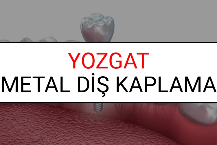 Yozgat Metal Diş Kaplama Fiyatları Ne Kadar? (2025 Yozgat TDB Metal Destekli Diş Fiyatları)