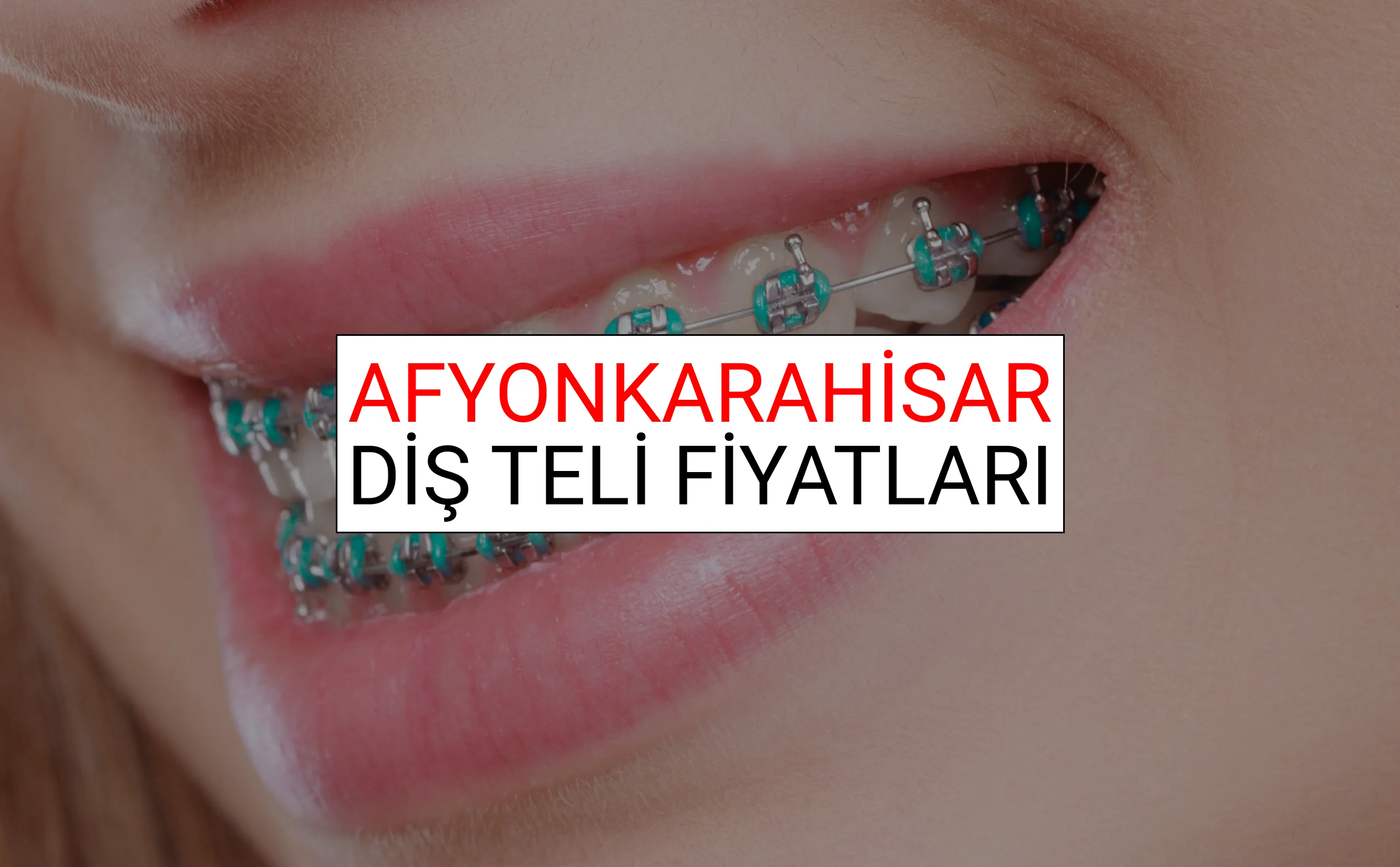 Afyonkarahisar Diş Teli Fiyatları Ne Kadar? (2025 Afyonkarahisar TDB Diş Teli Fiyatları)