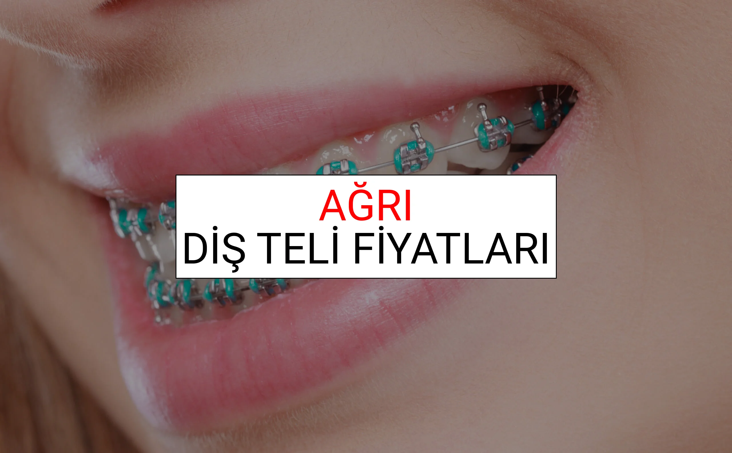 Ağrı Diş Teli Fiyatları Ne Kadar? (2025 Ağrı TDB Diş Teli Fiyatları)