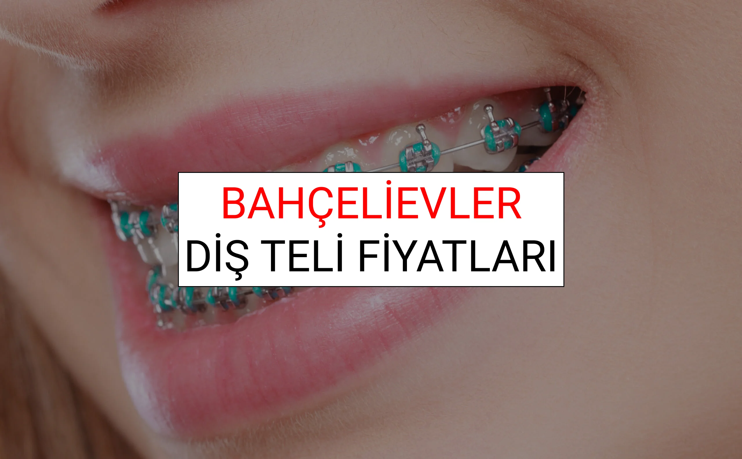 Bahçelievler Diş Teli Fiyatları Ne Kadar? (2025 Bahçelievler TDB Diş Teli Fiyatları)