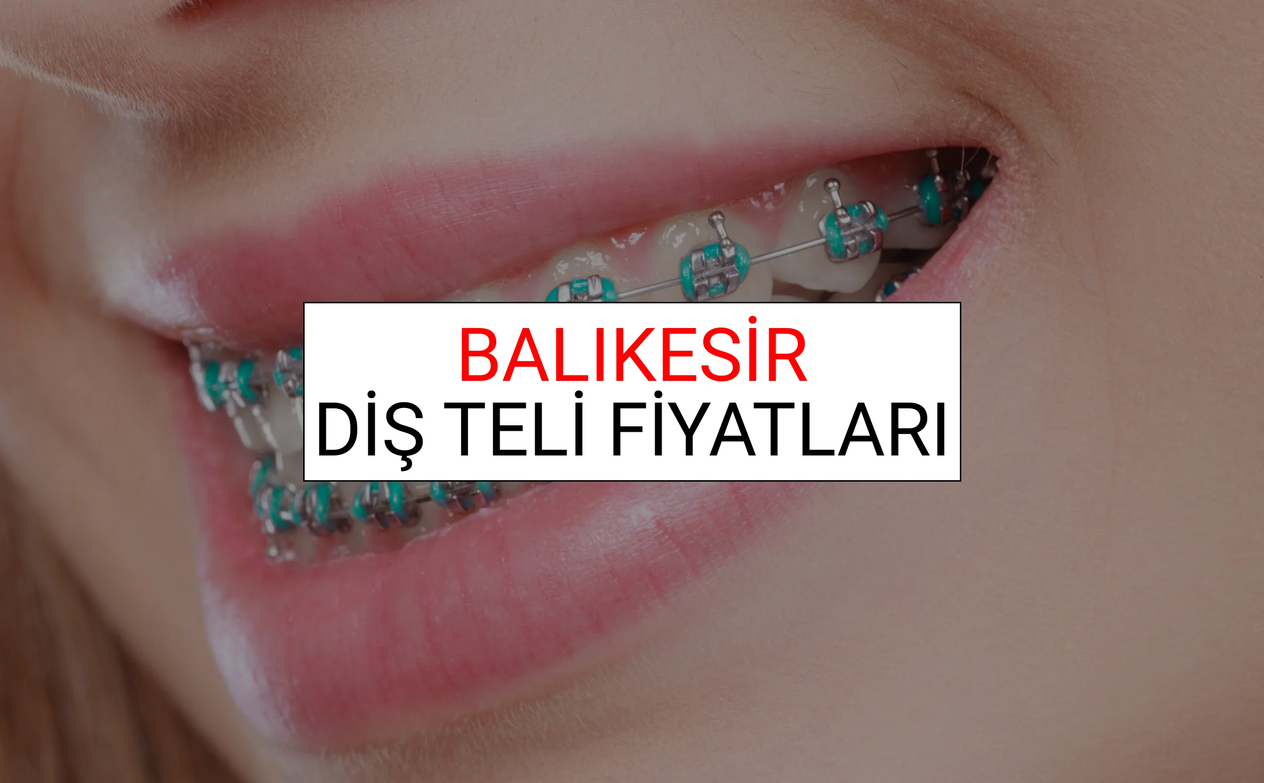 Balıkesir Diş Teli Fiyatları Ne Kadar? (2025 Balıkesir TDB Diş Teli Fiyatları)