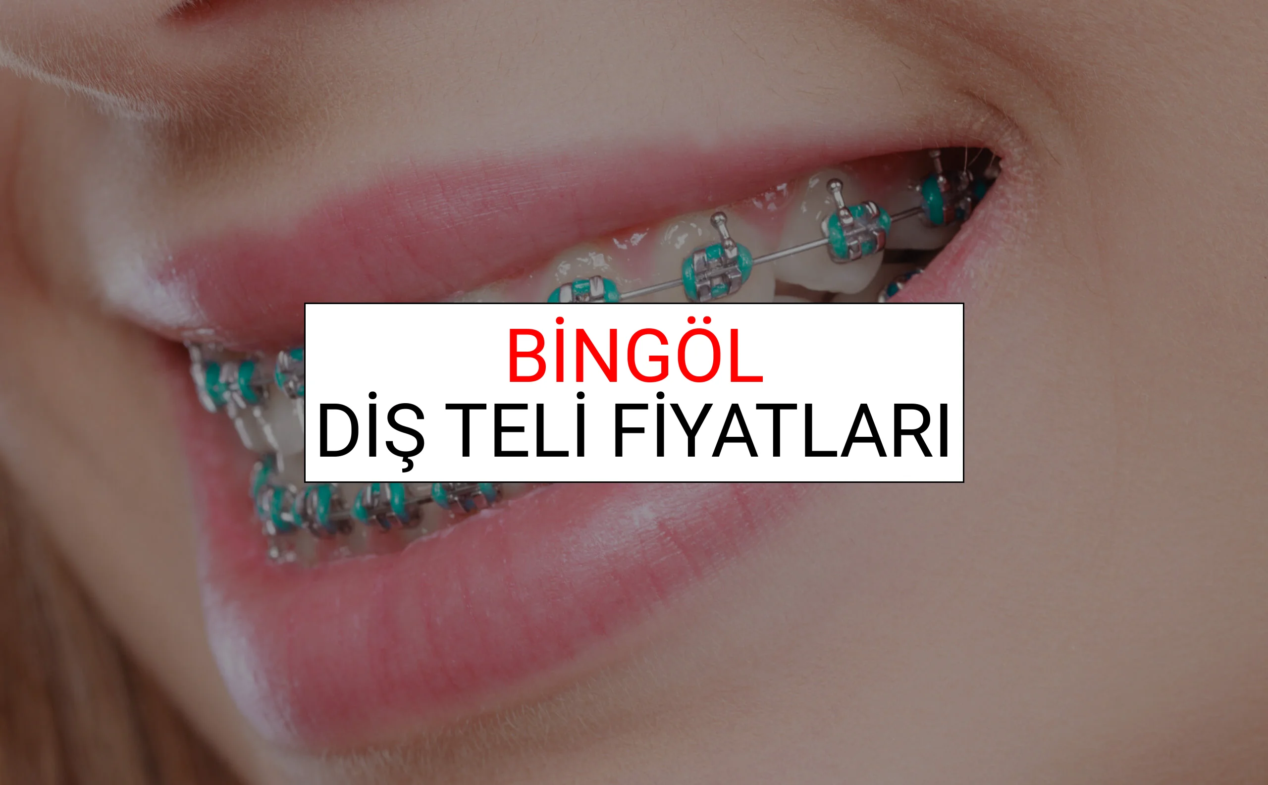 Bingöl Diş Teli Fiyatları Ne Kadar? (2025 Bingöl TDB Diş Teli Fiyatları)