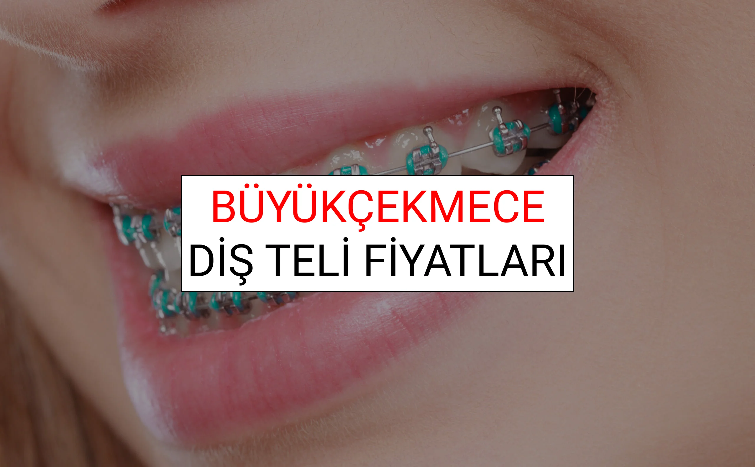 Büyükçekmece Diş Teli Fiyatları Ne Kadar? (2025 Büyükçekmece TDB Diş Teli Fiyatları)