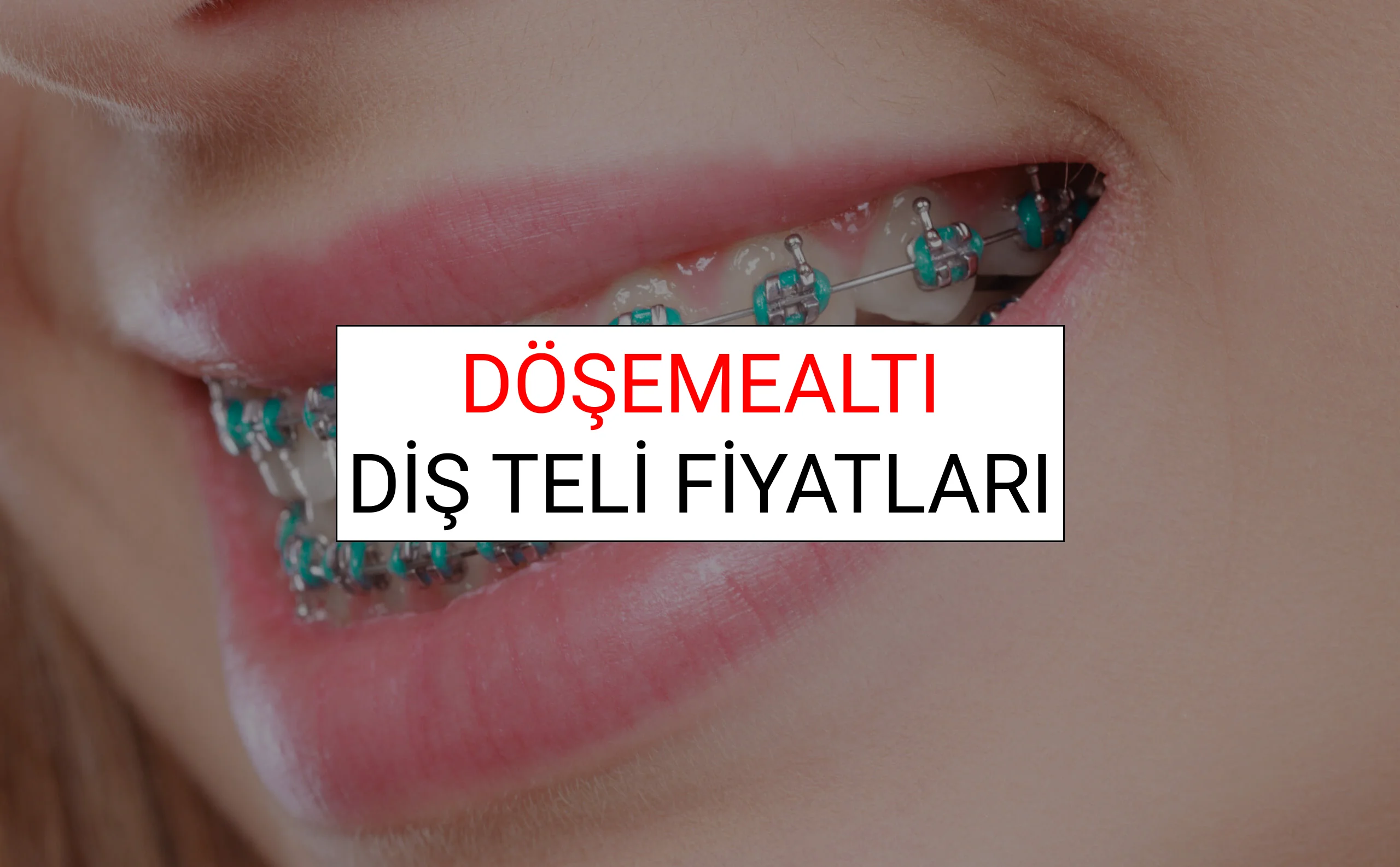 Döşemealtı Diş Teli Fiyatları Ne Kadar? (2025 Döşemealtı TDB Diş Teli Fiyatları)