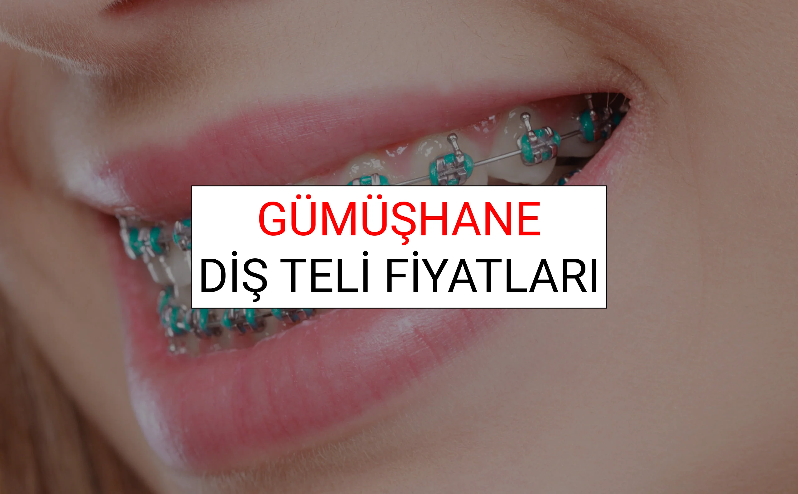 Gümüşhane Diş Teli Fiyatları Ne Kadar? (2025 Gümüşhane TDB Diş Teli Fiyatları)