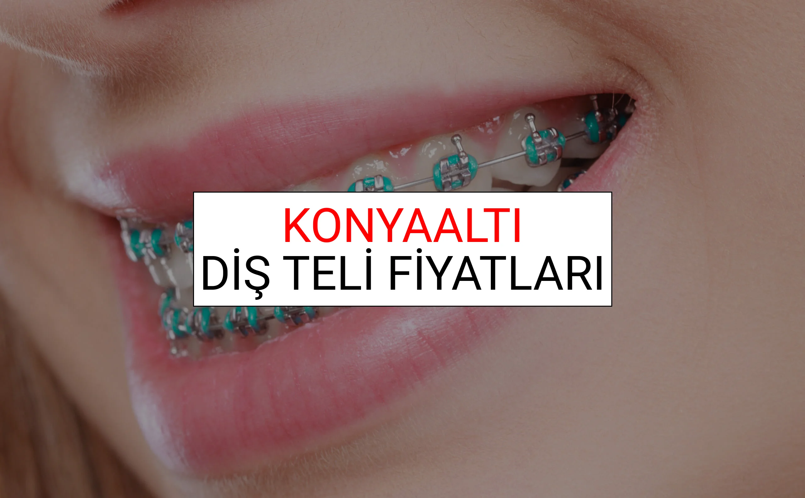 Konyaaltı Diş Teli Fiyatları Ne Kadar? (2025 Konyaaltı TDB Diş Teli Fiyatları)
