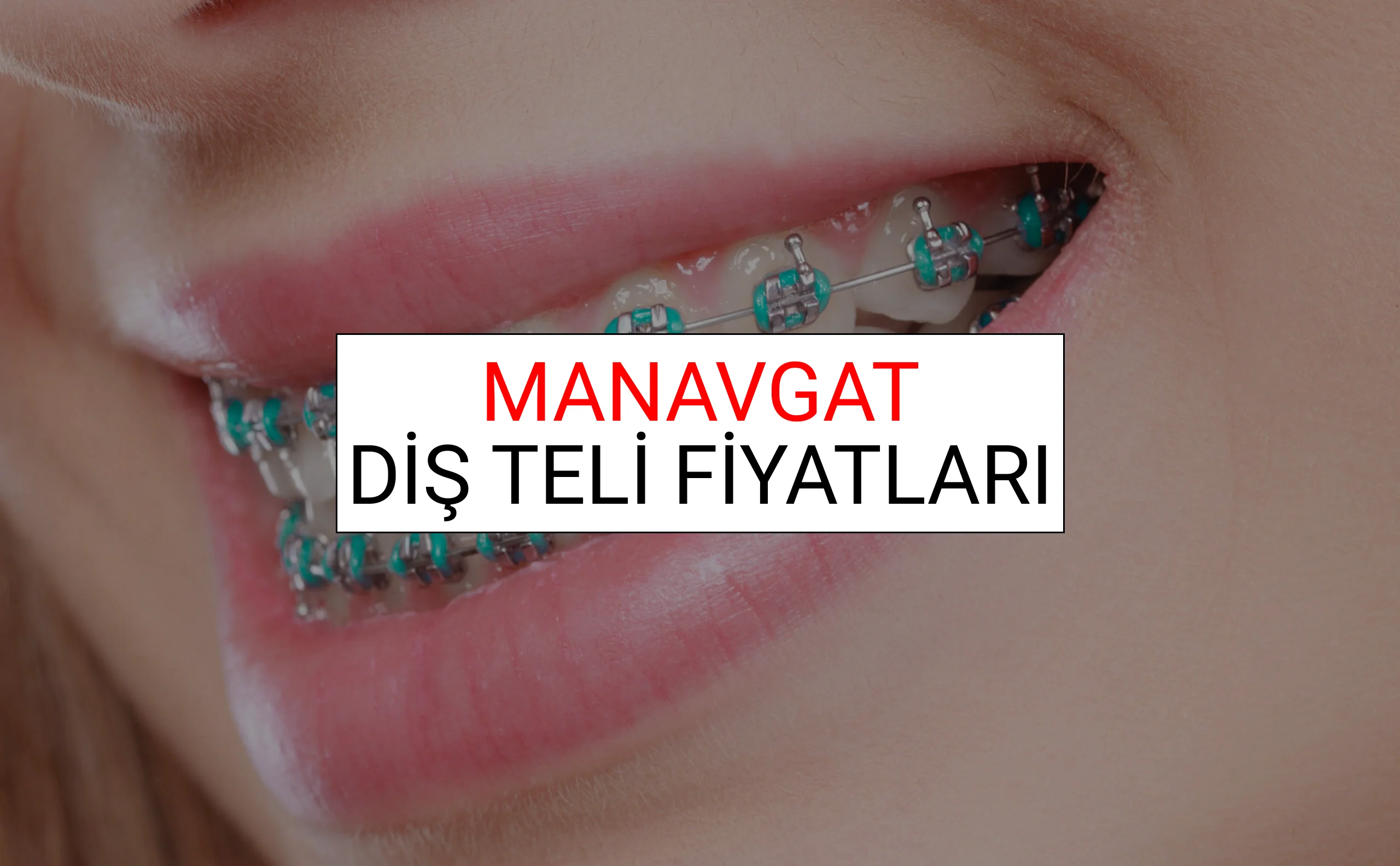 Manavgat Diş Teli Fiyatları Ne Kadar? (2025 Manavgat TDB Diş Teli Fiyatları)