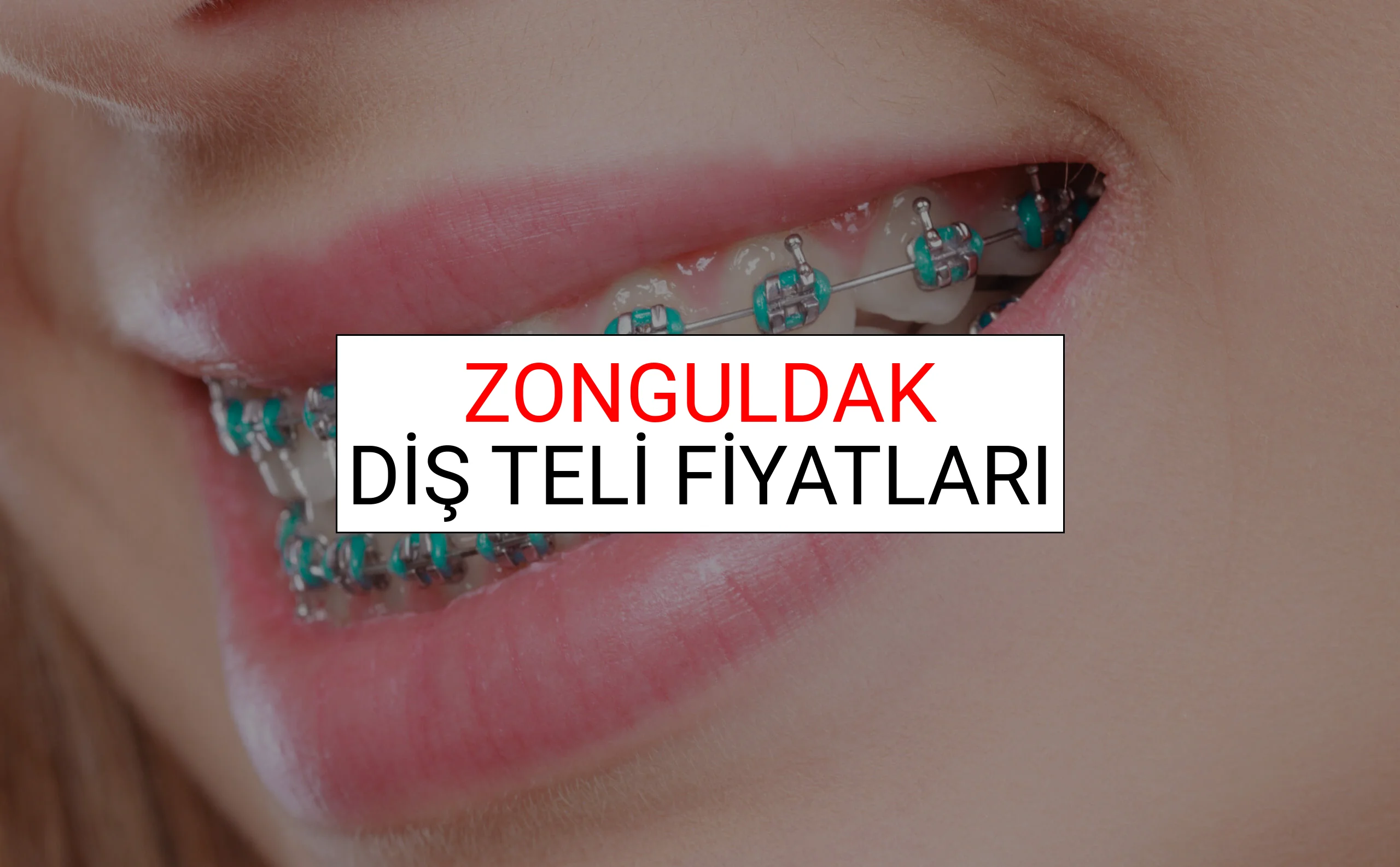 Zonguldak Diş Teli Fiyatları Ne Kadar? (2025 Zonguldak TDB Diş Teli Fiyatları)