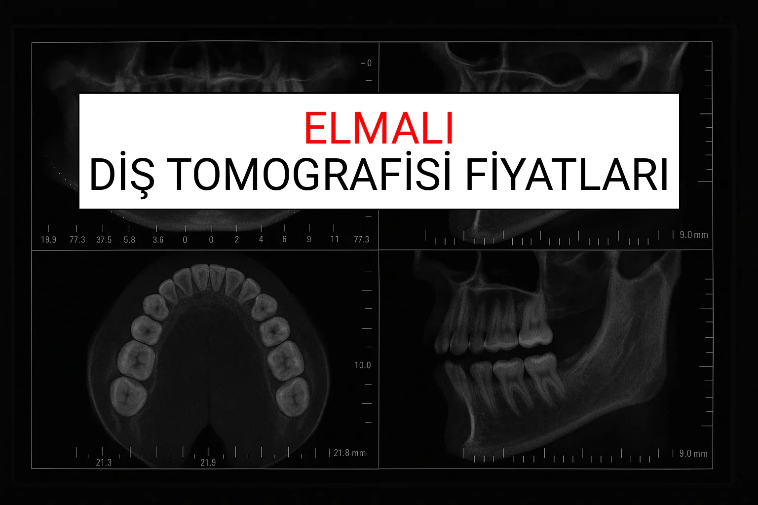 Elmalı Diş Tomografisi Fiyatları Ne Kadar? (2025 TDB Elmalı Diş Tomografisi Ücreti)