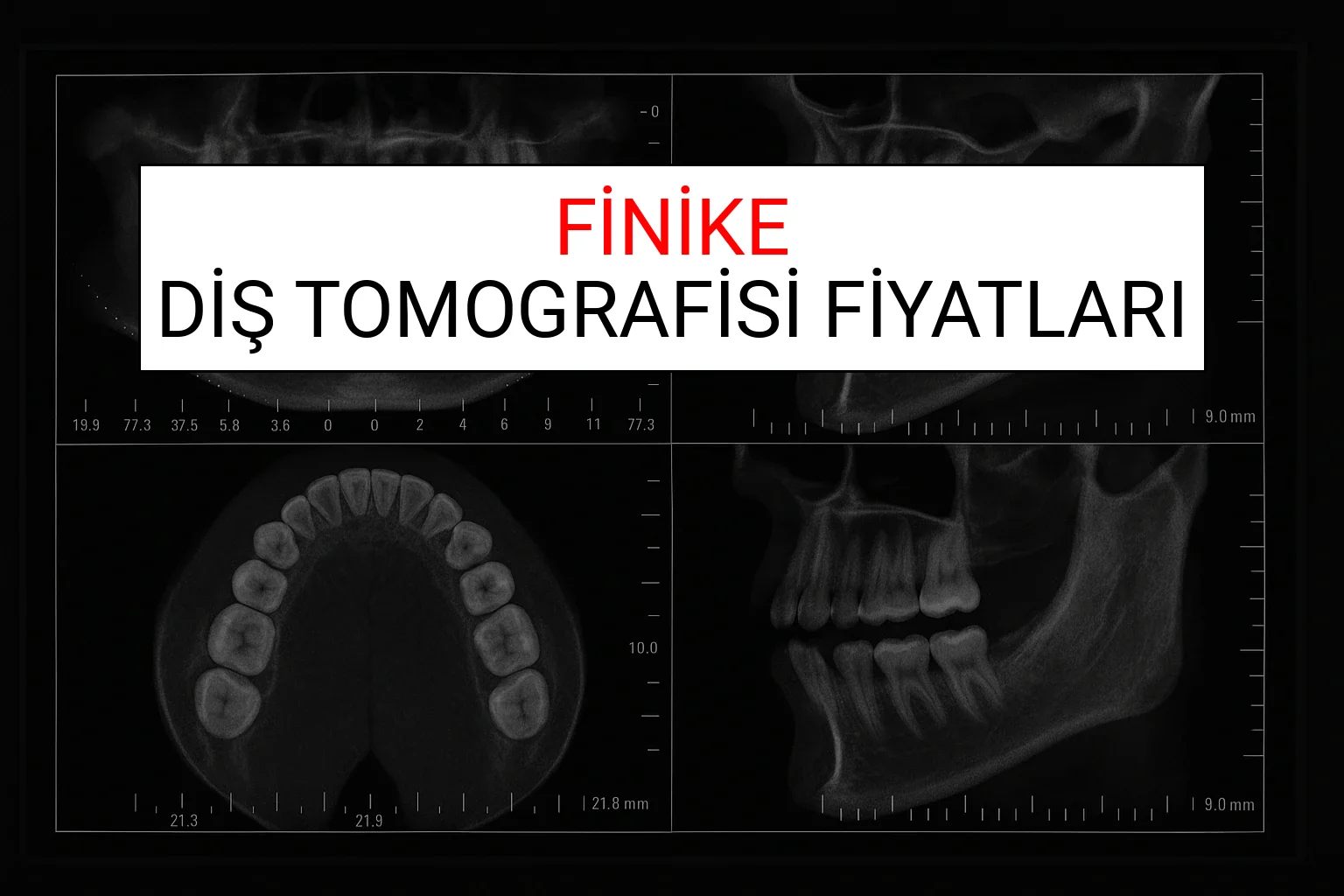 Finike Diş Tomografisi Fiyatları Ne Kadar? (2025 TDB Finike Diş Tomografisi Ücreti)