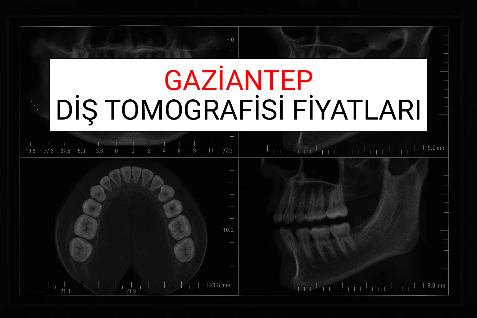 Gaziantep Diş Tomografisi Fiyatları Ne Kadar? (2025 TDB Gaziantep Diş Tomografisi Ücreti)