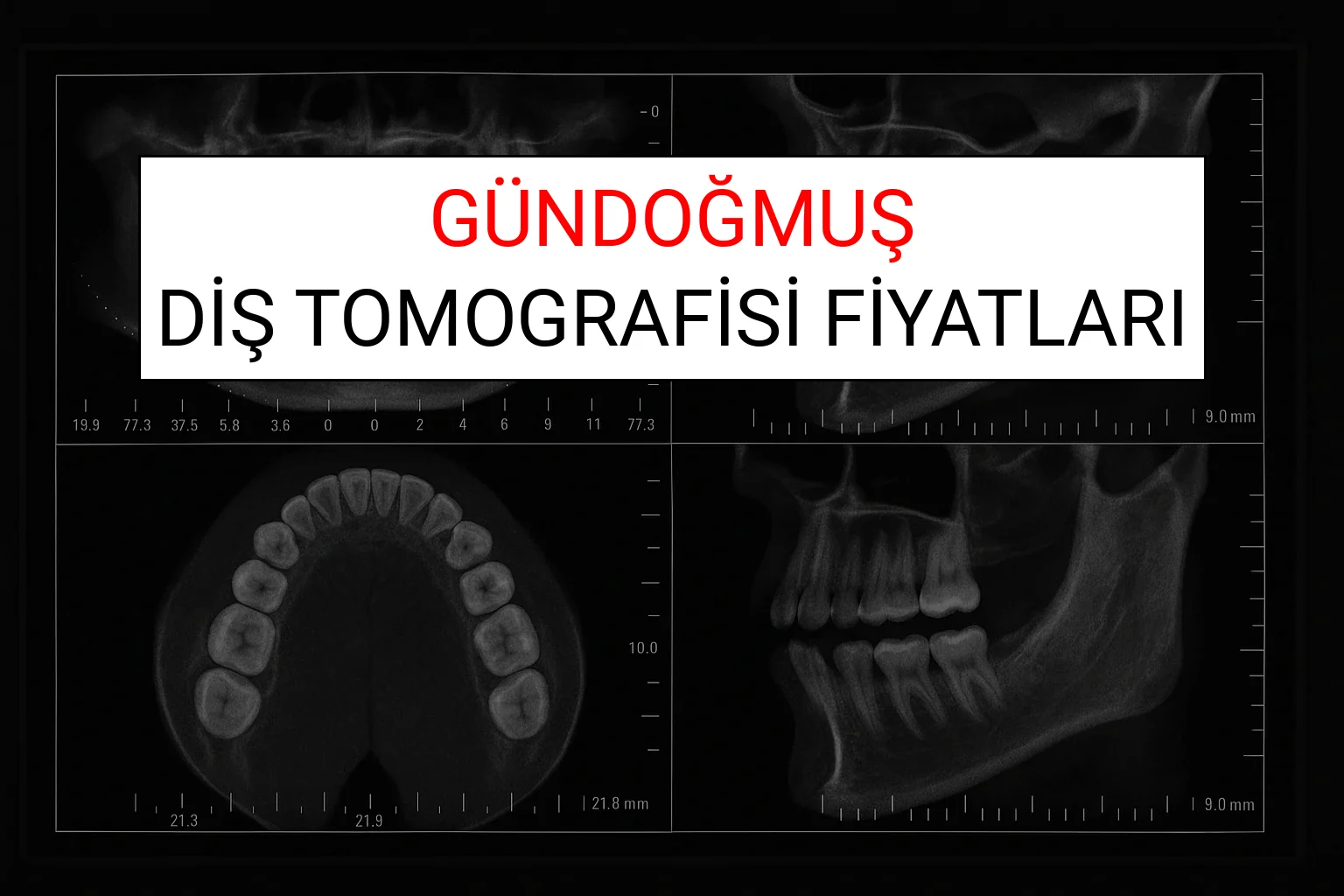 Gündoğmuş Diş Tomografisi Fiyatları Ne Kadar? (2025 TDB Gündoğmuş Diş Tomografisi Ücreti)