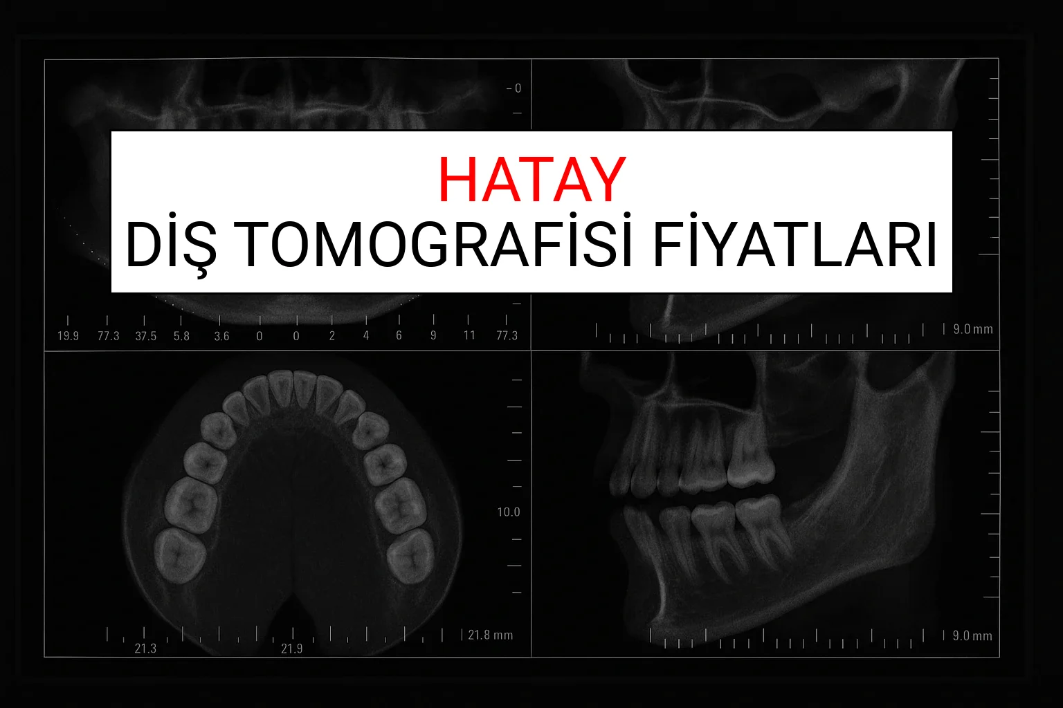 Hatay Diş Tomografisi Fiyatları Ne Kadar? (2025 TDB Hatay Diş Tomografisi Ücreti)