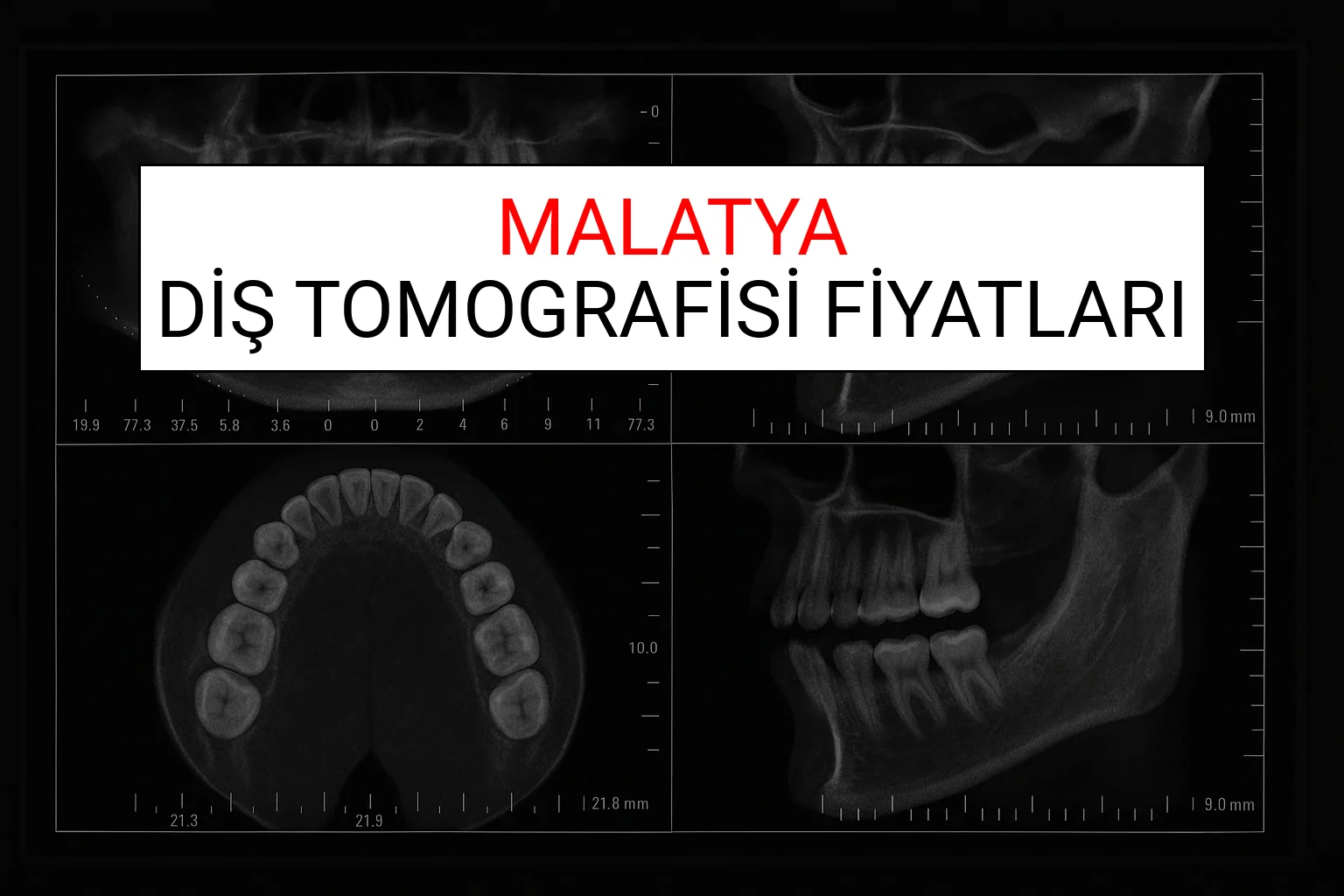 Malatya Diş Tomografisi Fiyatları Ne Kadar? (2025 TDB Malatya Diş Tomografisi Ücreti)