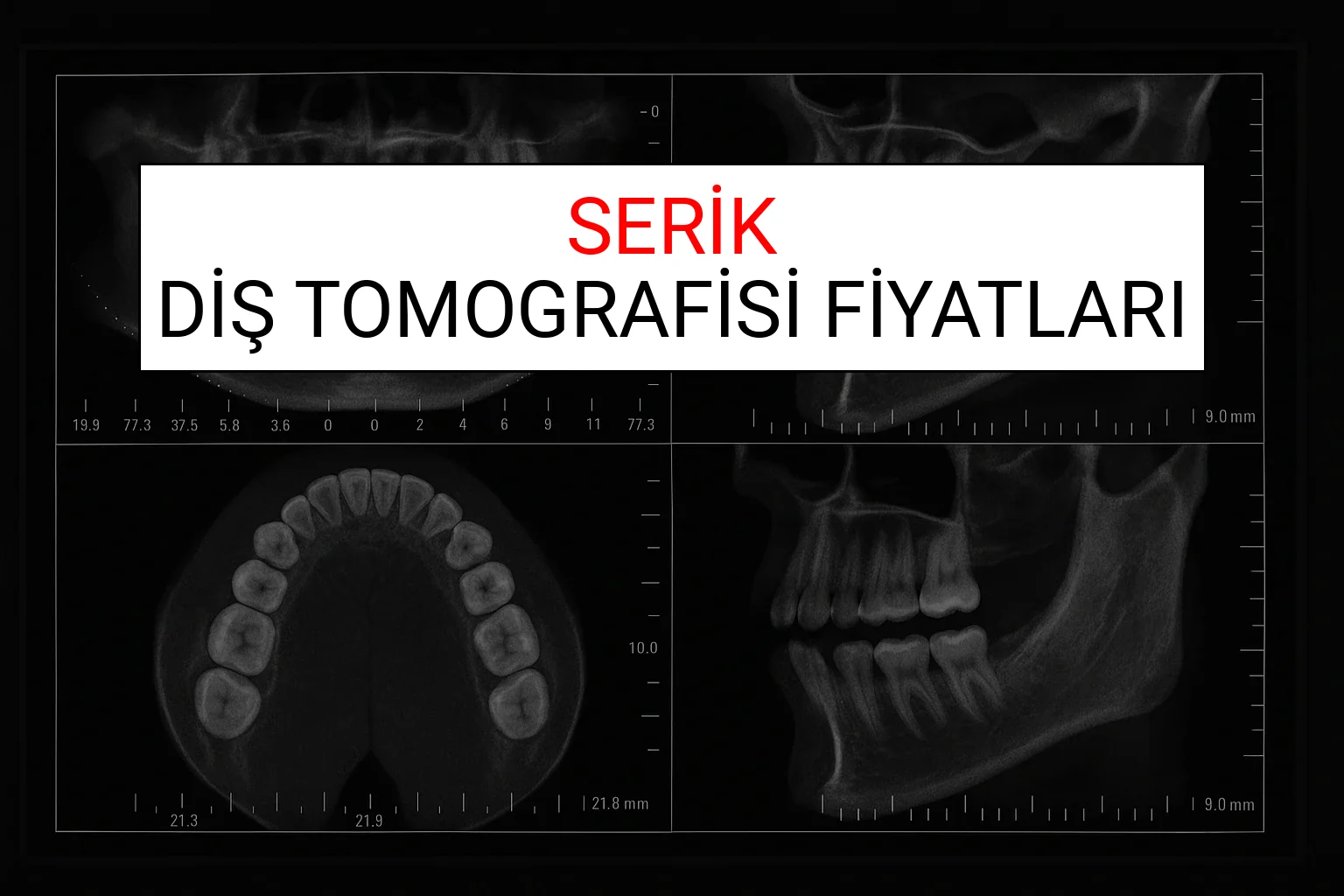 Serik Diş Tomografisi Fiyatları Ne Kadar? (2025 TDB Serik Diş Tomografisi Ücreti)