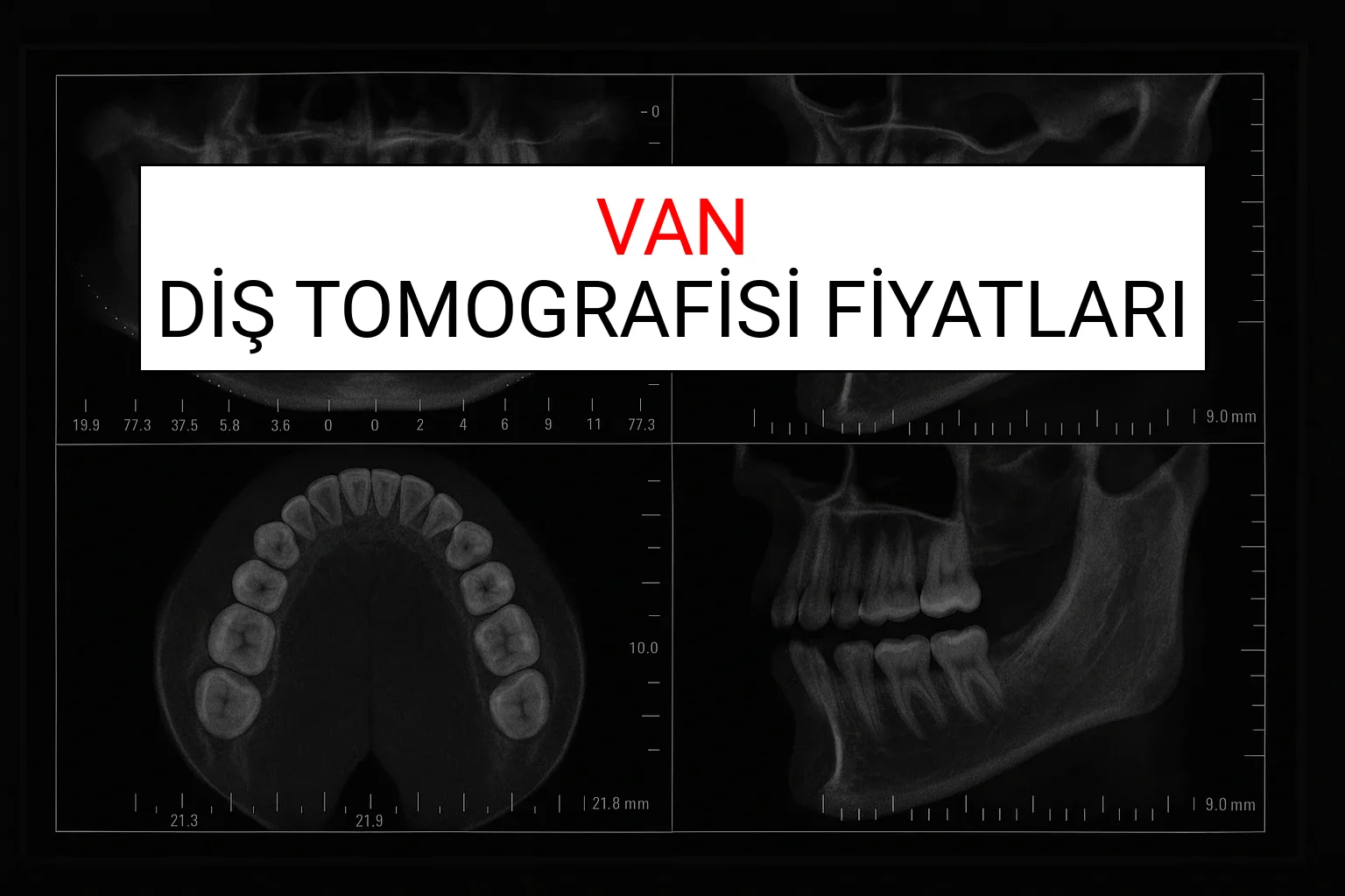 Van Diş Tomografisi Fiyatları Ne Kadar? (2025 TDB Van Diş Tomografisi Ücreti)