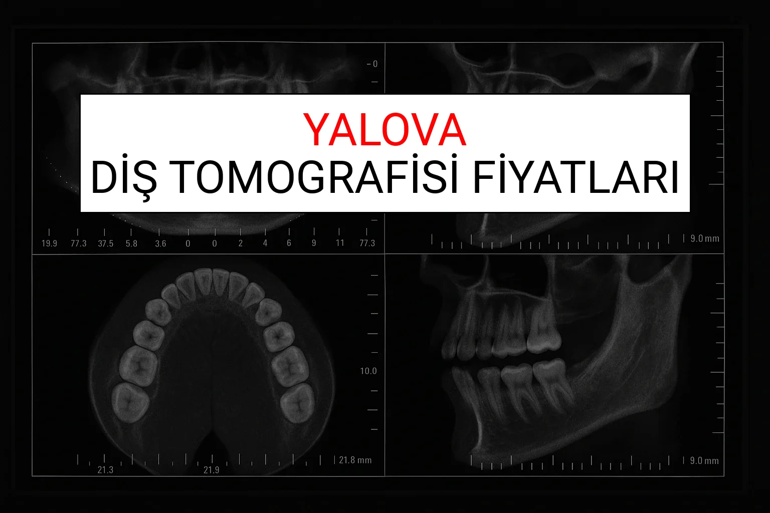 Yalova Diş Tomografisi Fiyatları Ne Kadar? (2025 TDB Yalova Diş Tomografisi Ücreti)